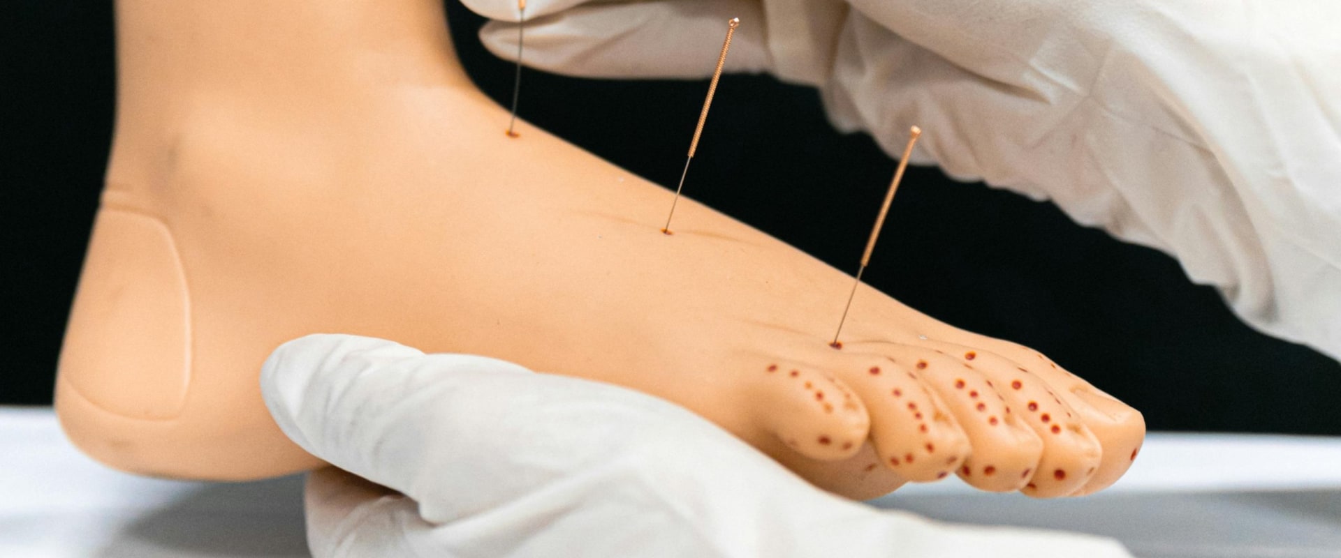 The Healing Power of Acupuncture for Neuropathy