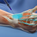 Managing Neuropathy at Home: The Benefits of Nerve Blocks