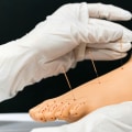 The Healing Power of Acupuncture for Neuropathy