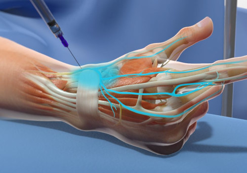 Managing Neuropathy at Home: The Benefits of Nerve Blocks
