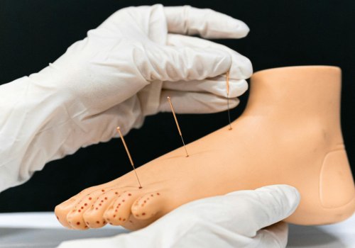 The Healing Power of Acupuncture for Neuropathy