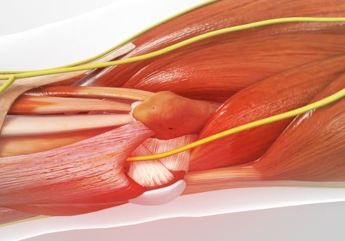 Expert Insights: Understanding Nerve Decompression Surgery for Neuropathy Treatment